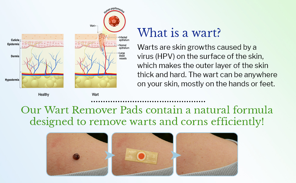 wart remover