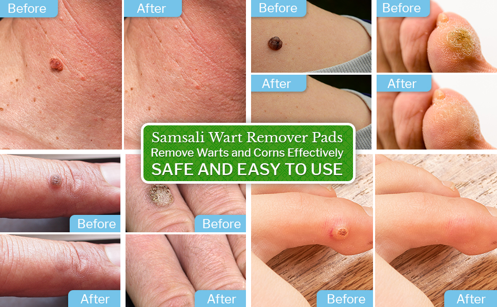 Wart remover