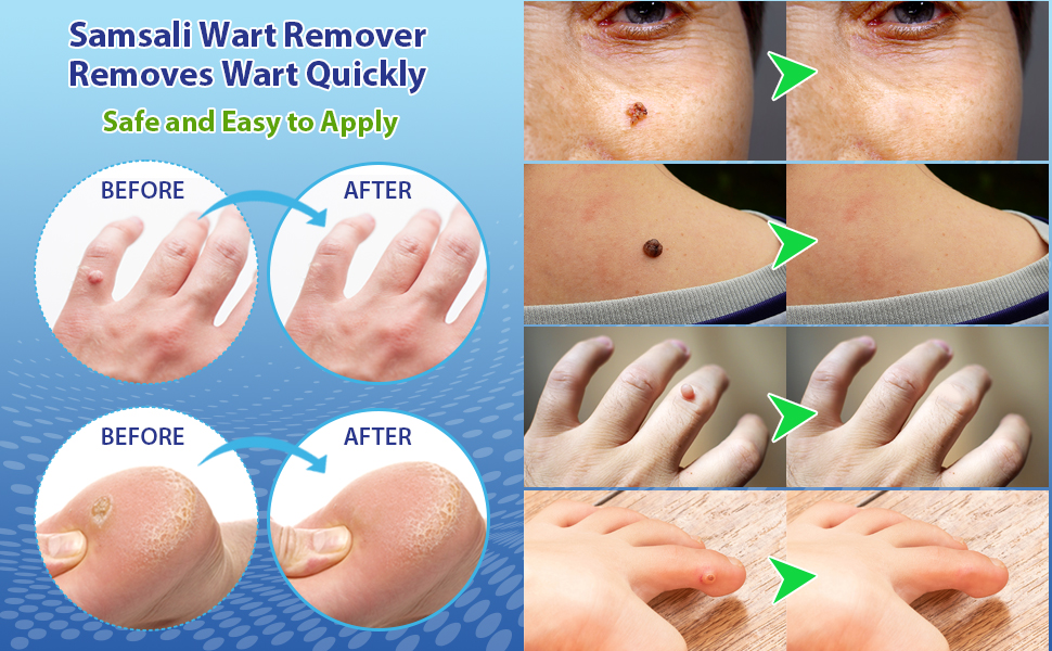 Wart Remover 3