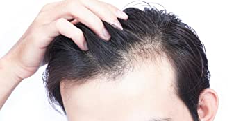 Reduce hair thinning