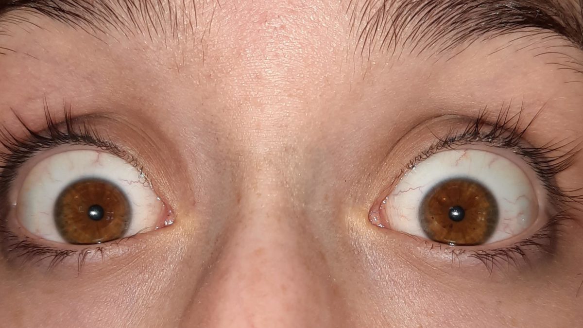 I’m really worried about my eyelashes on my left eye (right in the photo).  They are thinner than the ones to my right and seem to fall off more frequently.  I can’t wait for them not to grow back.  I can’t tell if this is normal or if something else is happening