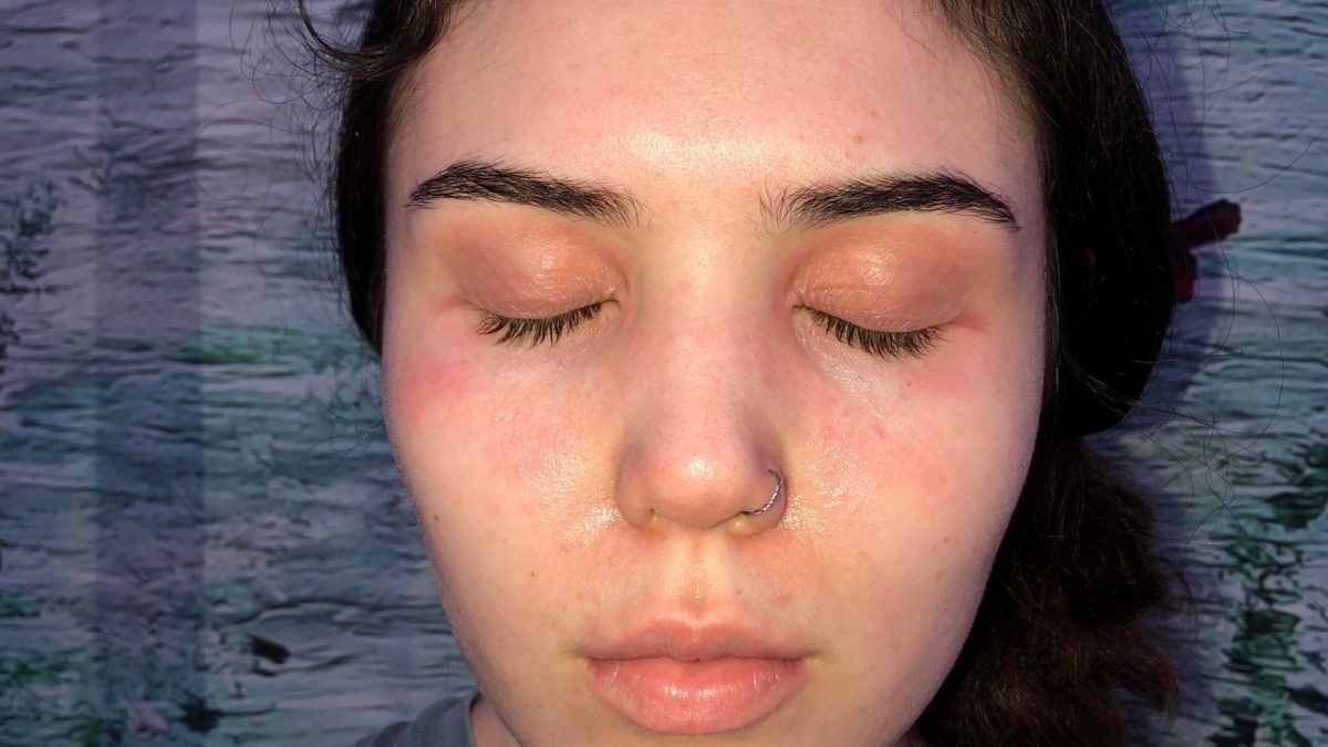 contact dermatitis due to makeup + seasonal bad allergies