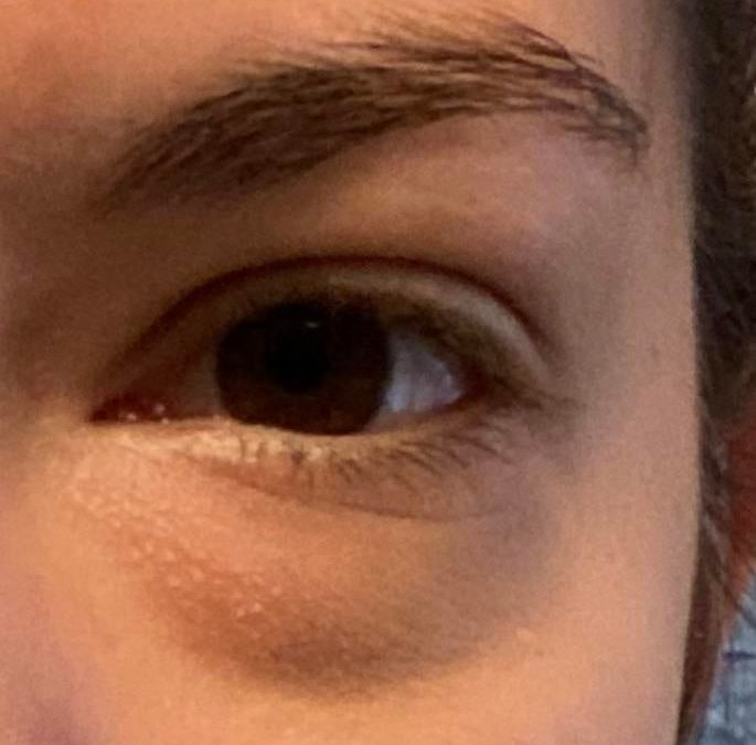 These horrible bags under the eyes and dark circles are genetic.  What color of color corrector should I use?  all other tips would be greatly appreciated!  :) tired of looking tired lol